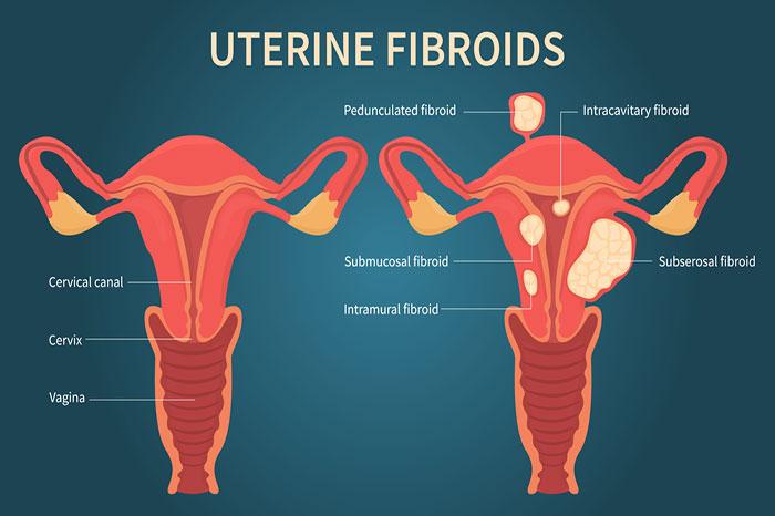 Uterine Fibroid: Causes, Symptoms, Treatment