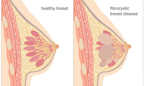 Breast Disease Treatment & Surgeries in Indore