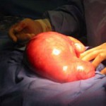 Gynecological Open Surgeries in Indore