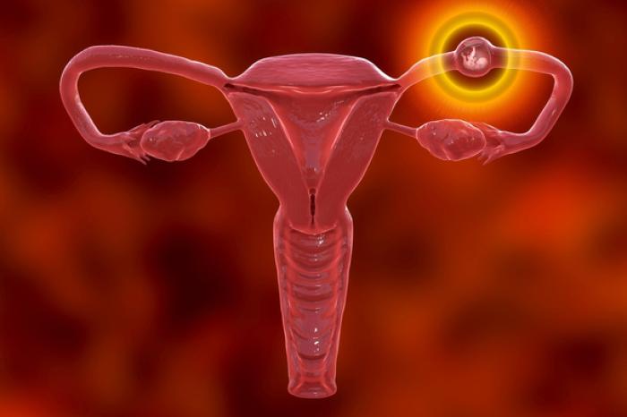 Management of Ectopic Pregnancy: What Every Woman Should Know