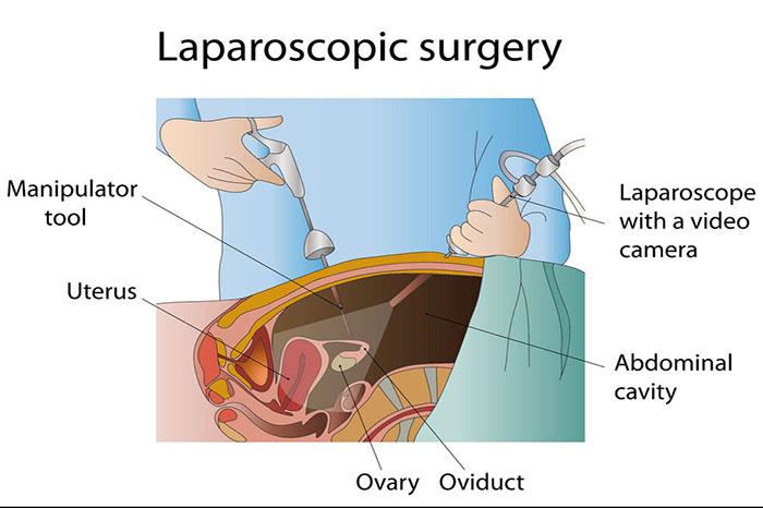 Laparoscopic Gynecological Surgeries