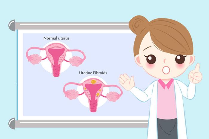 Uterine Fibroid